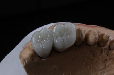 Implantes dentales de zirconio vs titanio
